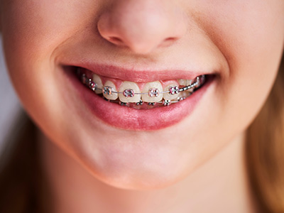 A smiling young woman with braces, showcasing her teeth and a confident expression.