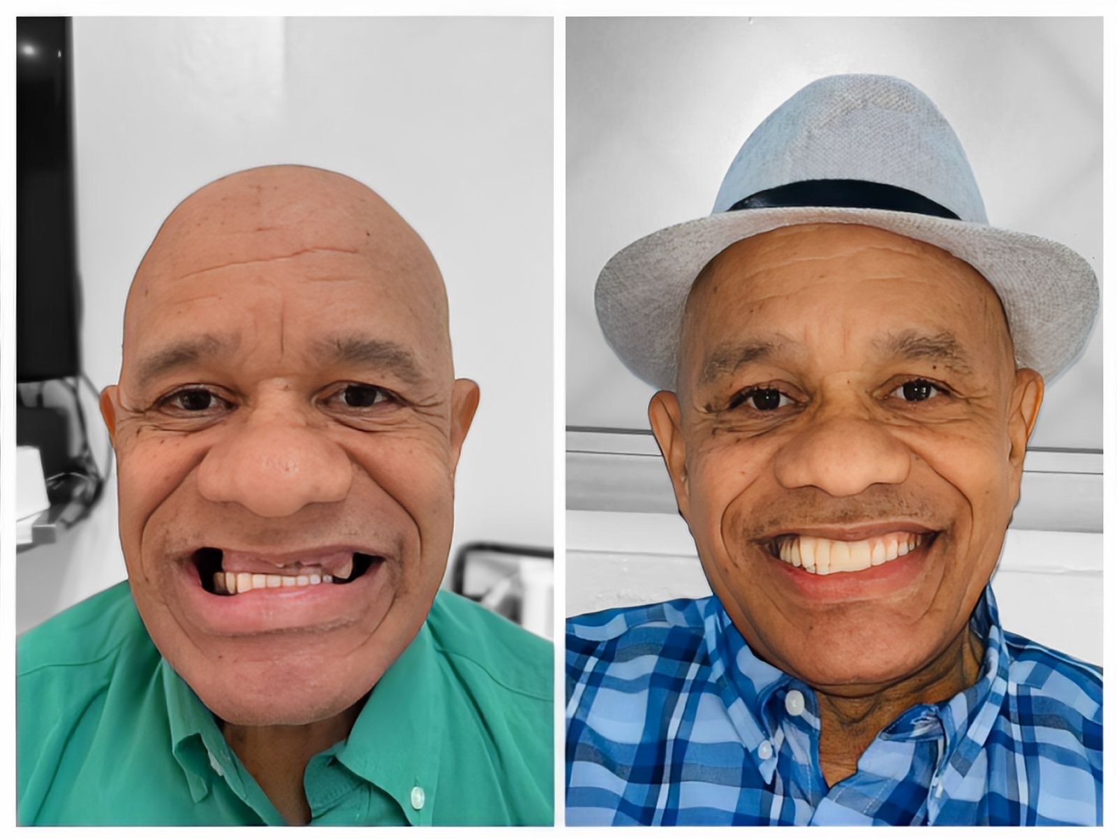 Hyline Dental | All-on-4 reg , Teeth Whitening and Snoring Appliances