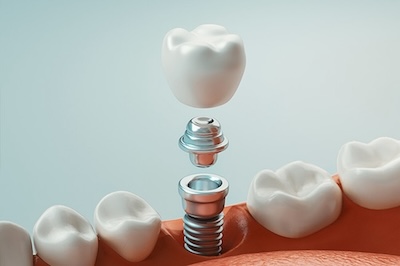 The image shows a close-up of a tooth with an implanted screw, which is likely a dental implant fixture, against a background that includes a mouth model and a single white tooth.