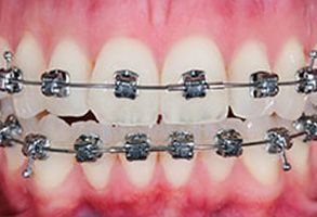 The image shows a close-up of a person s teeth with braces, featuring a metallic wire and brackets.