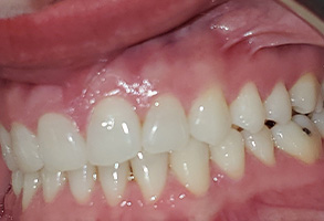 Hy Line Dental | CEREC, Sports Mouthguards and ZOOM  Whitening