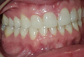 Hy Line Dental | Veneers, Orthodontics and Sports Mouthguards