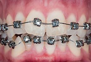 The image shows a close-up of a person s teeth with braces, featuring silver and clear brackets.