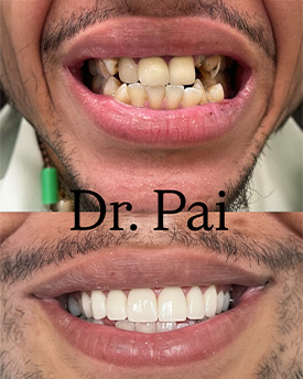 Hyline Dental | Veneers, Snoring Appliances and ZOOM  Whitening