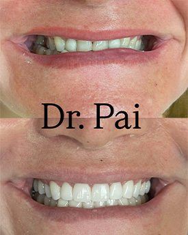 Hyline Dental | Root Canals, Invisalign reg  and Botox reg 