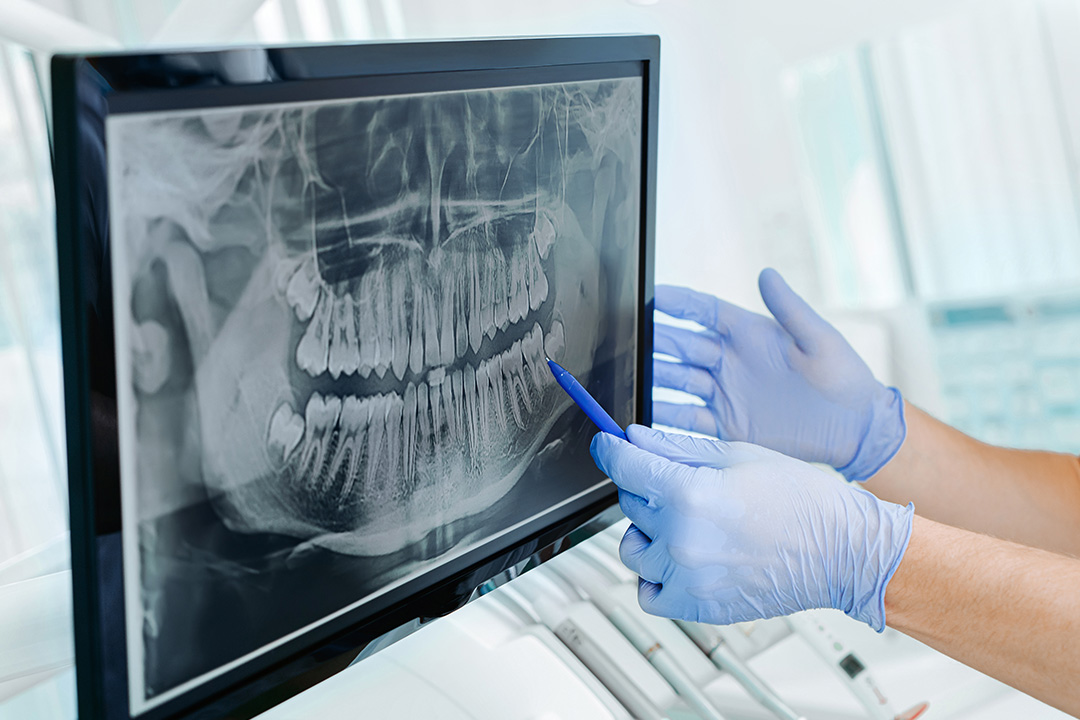A dental professional wearing gloves and a face mask, examining a digital X-ray of a patient s teeth on a computer screen.
