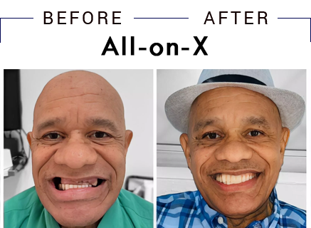 Hyline Dental | All-on-4, Dermal Fillers and Veneers