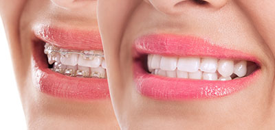 A split-screen photo of a person smiling with teeth, showing the difference between natural and cosmetic teeth.