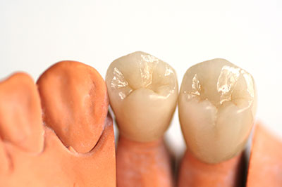 A pair of human teeth displayed side by side, with one showing signs of decay and the other appearing healthy.