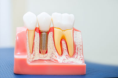 An image of a dental model with multiple teeth, showcasing the process of dental implants or bridges, featuring screws and artificial tooth roots.