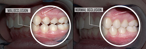 The image shows a side-by-side comparison of a person s teeth with and without a dental implant, highlighting the difference in appearance and function.