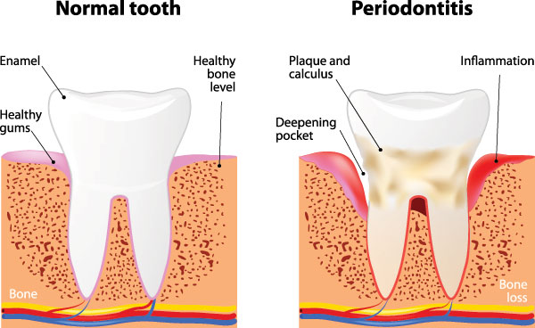 The image is a medical illustration showing the stages of tooth decay, from normal to severe, with text labels indicating the different levels of damage and the resulting dental health issues.