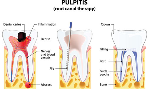 The image is a medical illustration showing the anatomy of a tooth, with labels indicating dental structures and processes such as pulpitis, root canal therapy, and the presence of a dental drill.