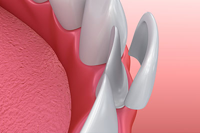 The image shows a close-up of a dental implant fixture with a pink gum tissue background, highlighting the metallic structure and screws.