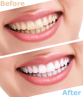 The image displays a side-by-side comparison of a person s teeth before and after dental treatment, showcasing the transformation through tooth whitening.