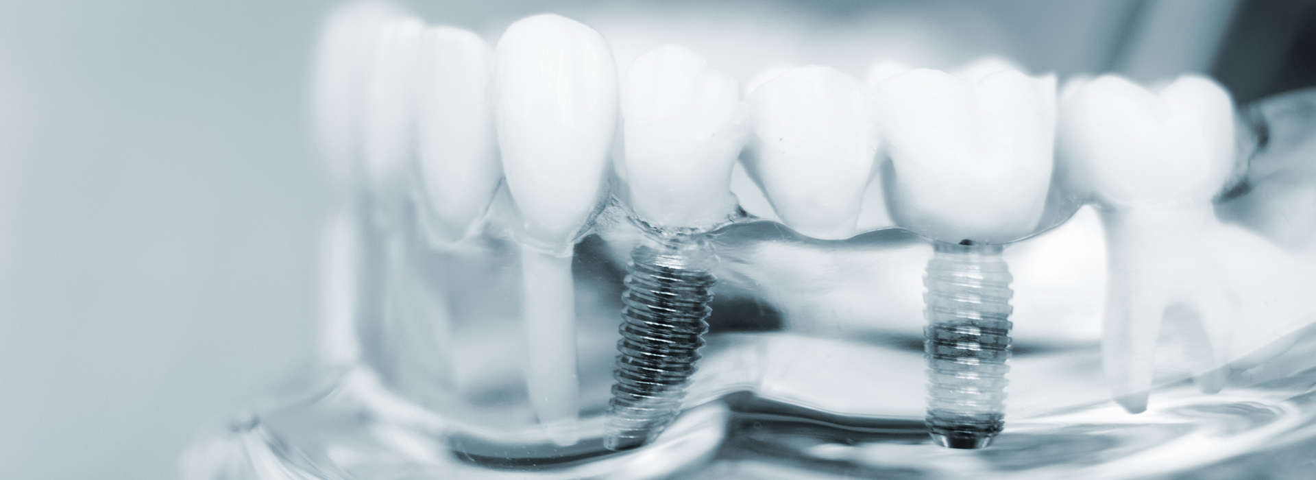 The image shows a close-up of a set of teeth with visible braces, against a blurred background that resembles a laboratory or dental office setting.