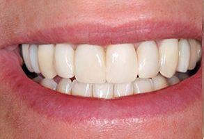 The image shows a person with a wide smile, displaying straight white teeth and a visible dental implant on the upper left side of their mouth.