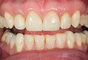 The image shows a close-up of a person s teeth with a focus on the lower front teeth, which appear to be discolored or stained.