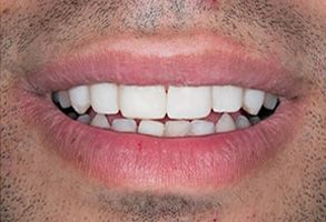 The image shows a close-up of a person s smiling face with teeth, featuring a beard and mustache.