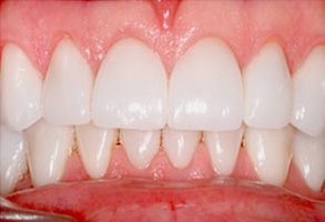 The image shows a close-up of a person's teeth, displaying a bright smile with white teeth and pink gums.