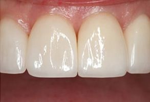 An image of a person's teeth with a focus on a set of white, straight front teeth.