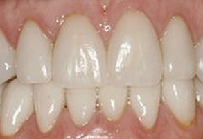 The image shows a close-up of a person's teeth, which appear to be in the process of being straightened or aligned, with braces visible on the upper front teeth.