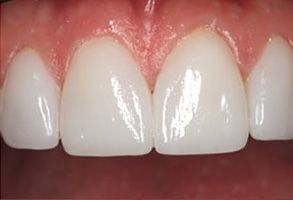The image shows a close-up of a person s teeth, with the focus on the lower front teeth that appear to be in good condition and possibly undergoing cosmetic dental treatment.