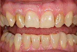 The image displays a close-up of two rows of teeth with a pinkish gumline, showcasing the upper and lower dental arches.