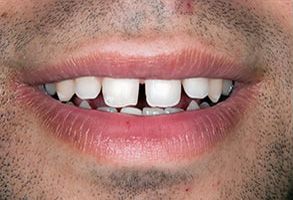 Image  A man s smiling face with a focus on his open-mouthed teeth and lips, showcasing an orthodontic appliance.