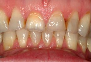 The image is a close-up photograph of an open mouth displaying a set of teeth with yellow staining, particularly noticeable on the lower front teeth.