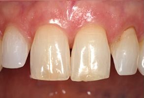 The image shows a close-up of a person's teeth, with the focus on a tooth that appears to be in need of dental work due to discoloration and decay.