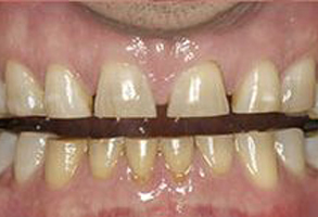 The image shows a close-up of a person's mouth with teeth that appear to be in poor condition, possibly due to decay or neglect.