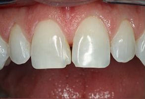 The image shows a close-up of a person s mouth with visible teeth, including a lower front tooth that appears to be chipped or broken.